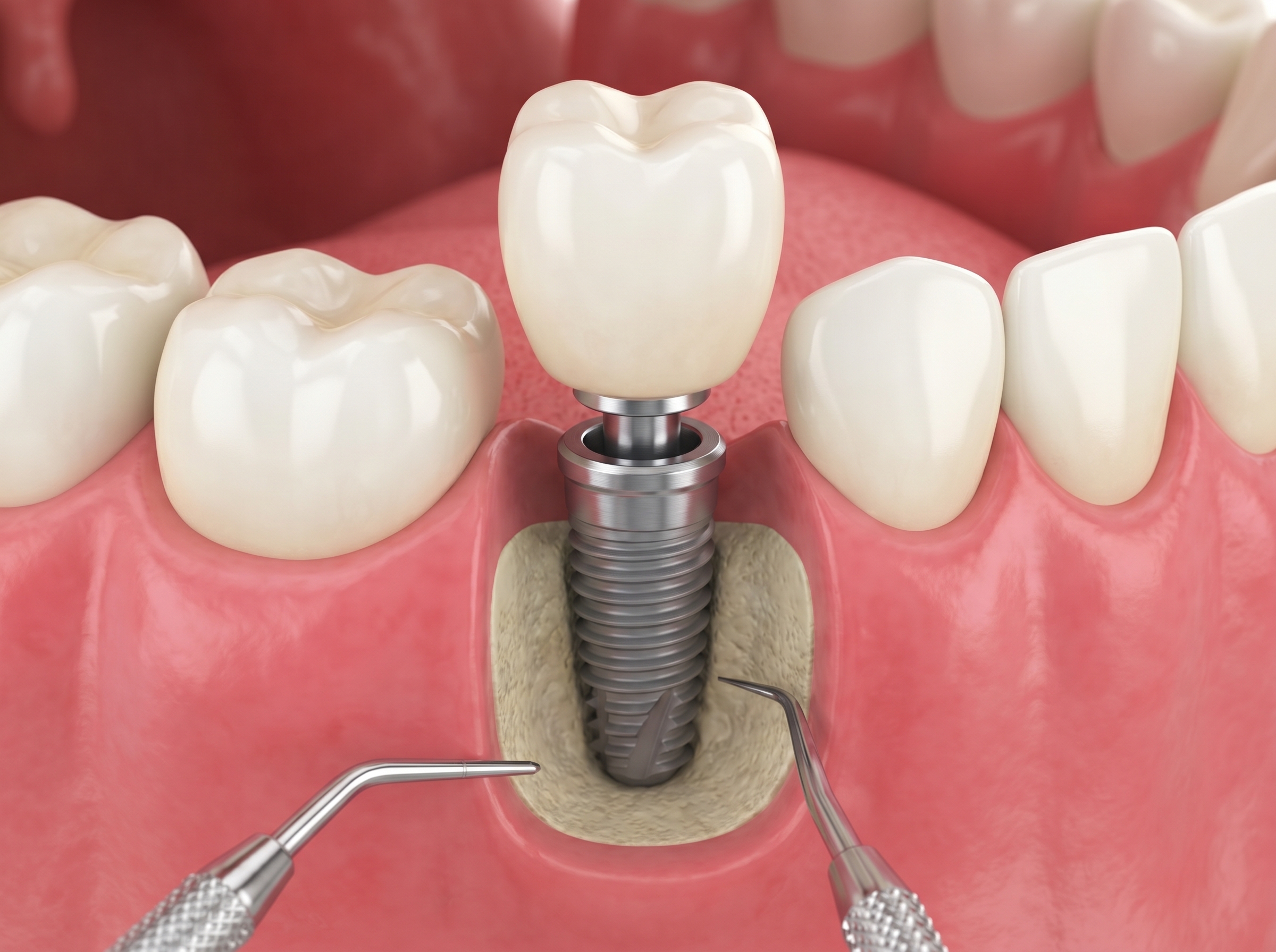 Prix de l'Implant Dentaire au Maroc : Guide Complet - Dr Reda Fadil Dentiste Casablanca